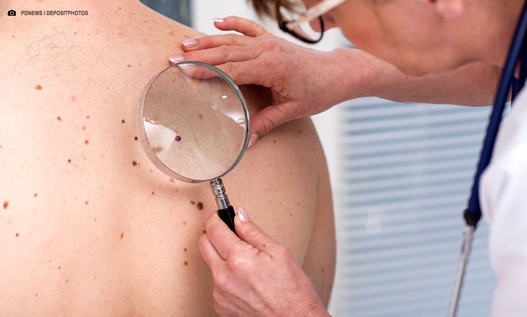 HRAN recebe força-tarefa para diagnóstico de câncer de pele neste sábado