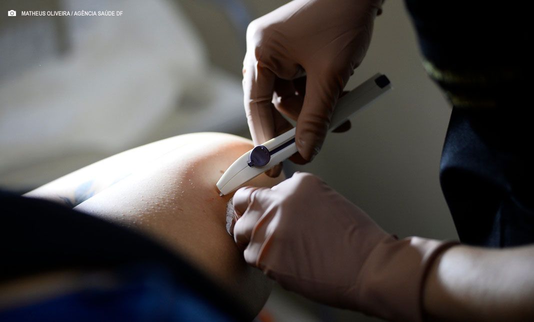 Implanon: novo método contraceptivo está disponível nas unidades básicas de saúde do DF