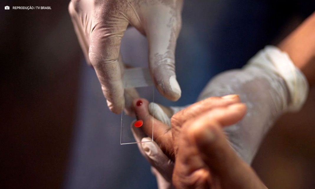 SUS inicia tratamento inédito contra malária em crianças com medicamento de dose única