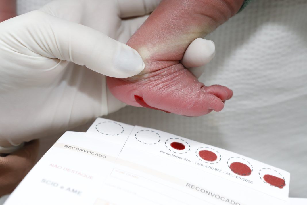 DF é pioneiro no diagnóstico precoce da doença de Fabry com o teste do pezinho DF é pioneiro no diagnóstico precoce da doença de Fabry com o teste do pezinho