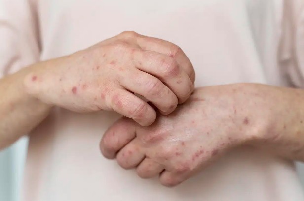 No Dia Mundial do Lúpus, especialista reforça importância de reconhecer os sintomas No Dia Mundial do Lúpus, especialista reforça importância de reconhecer os sintomas