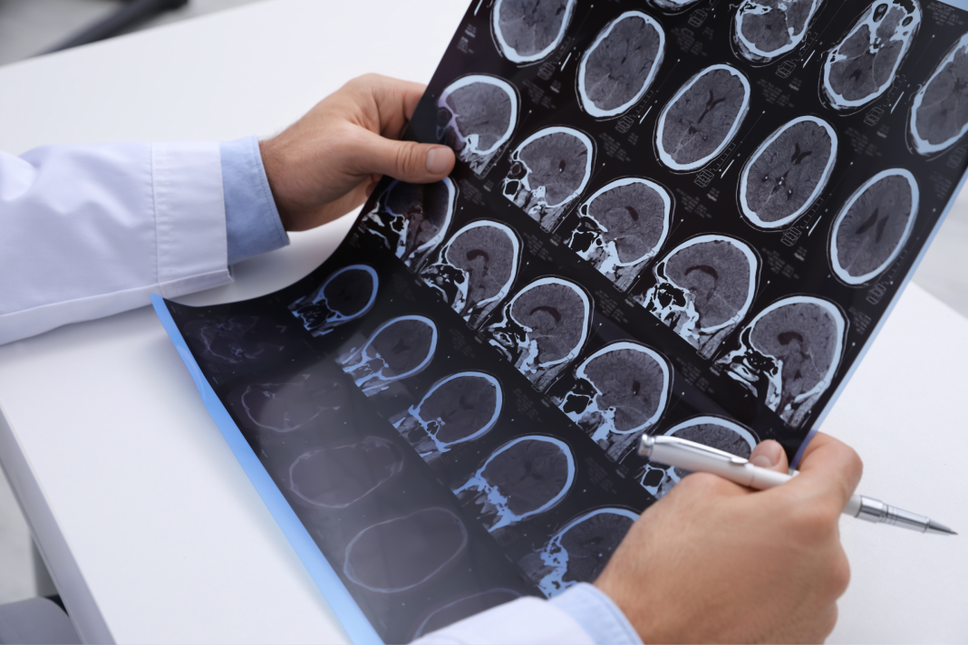 Esclerose múltipla é a principal causa de incapacidade neurológica em jovens adultos Esclerose múltipla é a principal causa de incapacidade neurológica em jovens adultos