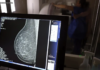 Médicos lançam guia para evitar recusa de mamografia digital