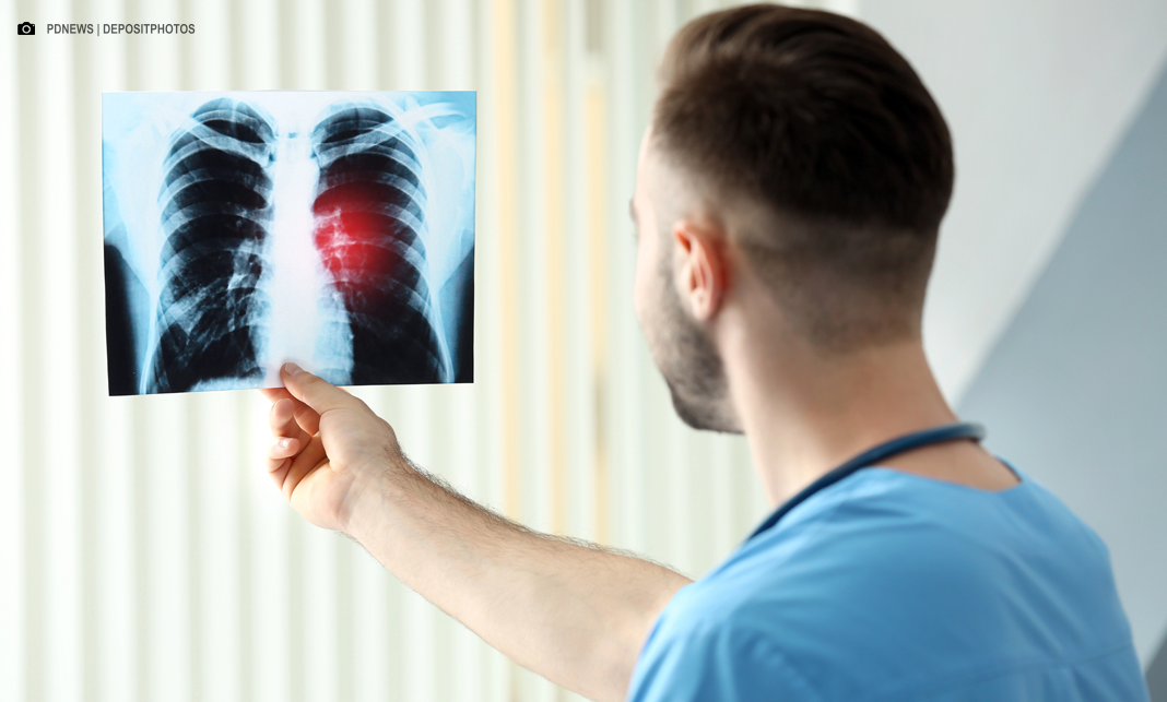 Anvisa aprova novo medicamento para câncer de pulmão avançado Anvisa aprova novo medicamento para câncer de pulmão avançado